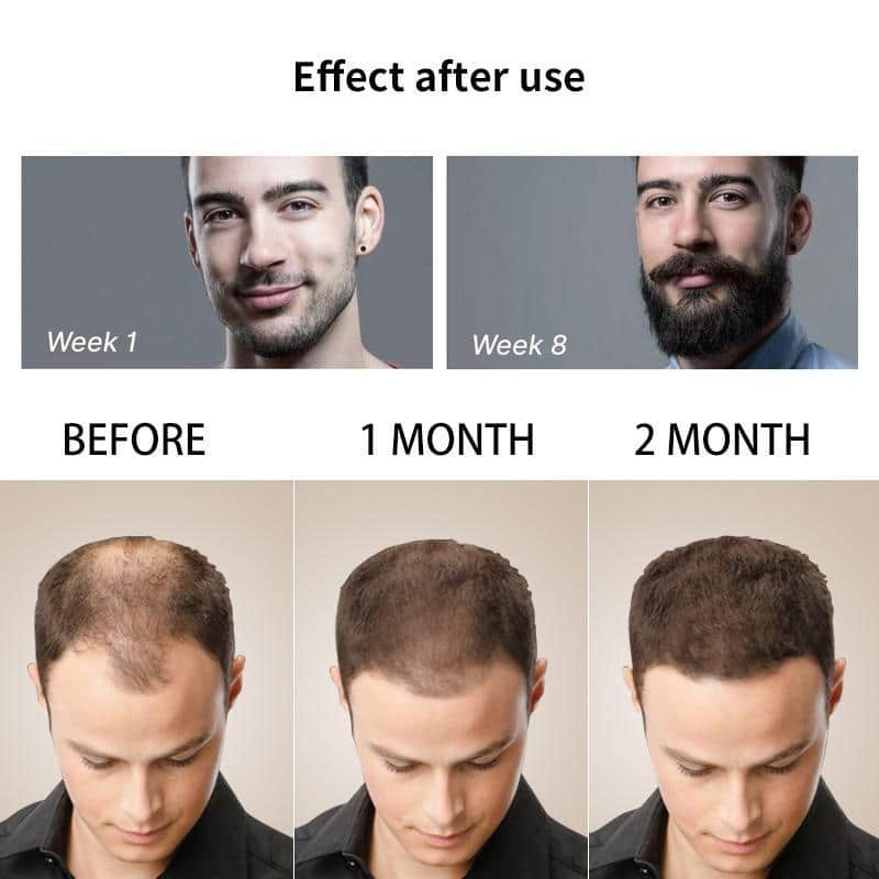 Beard Growth Roller Set