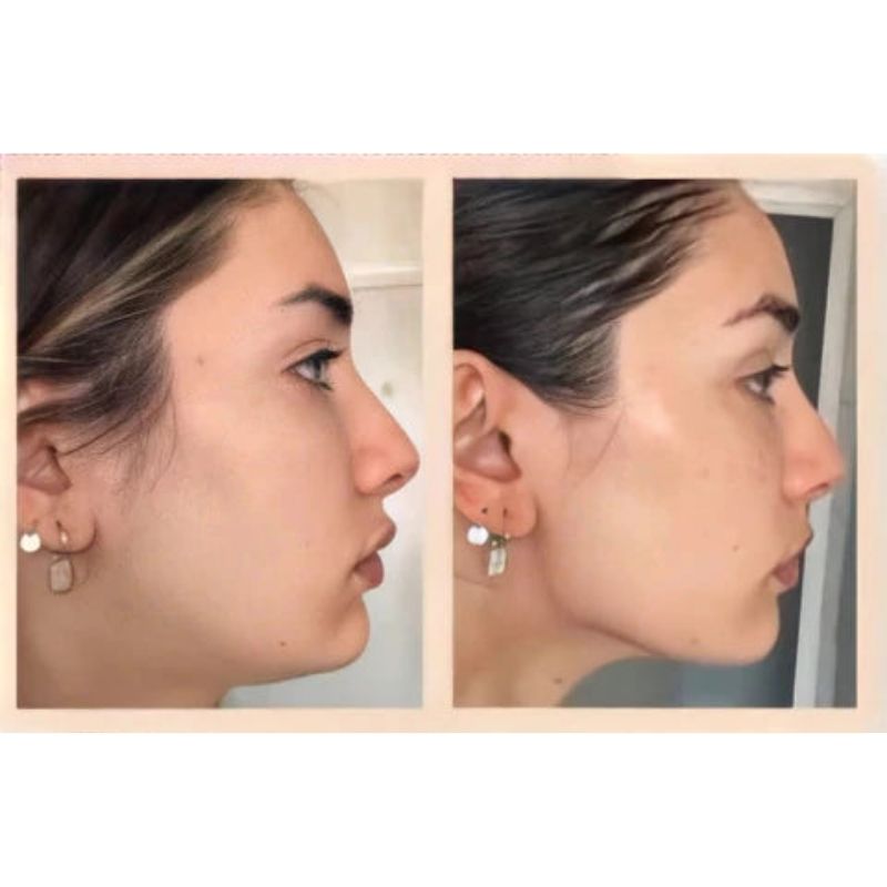 Microcurrent skin tightening