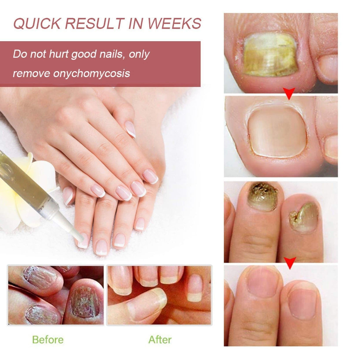 Anti-Fungal Home Treatment Set