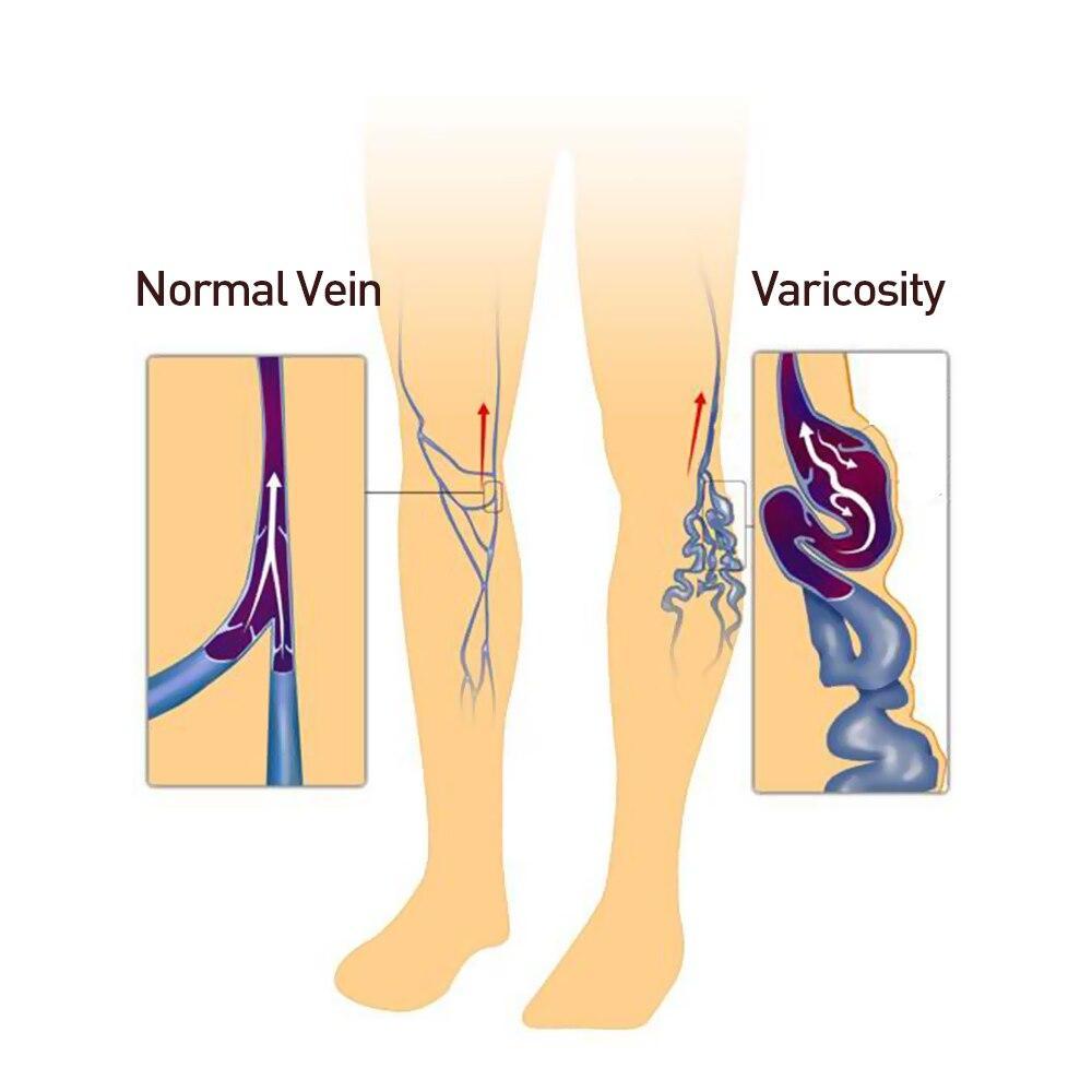 Varicose Veins Miracle Cream
