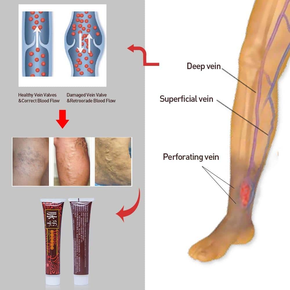 Varicose Veins Miracle Cream